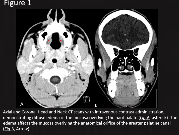 CT findings of NS